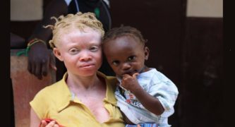Malawi Albinos Set Up Protest Camp, Demand to Meet President